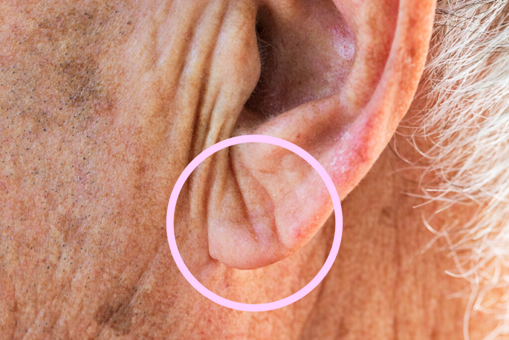 Close up of ear with crease circled