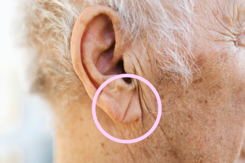 Close up of ear with crease circled