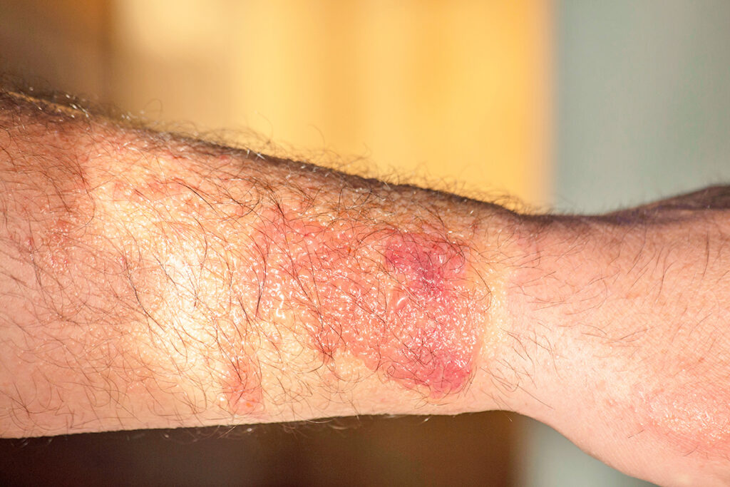 Phytophoto dermatitis reaction