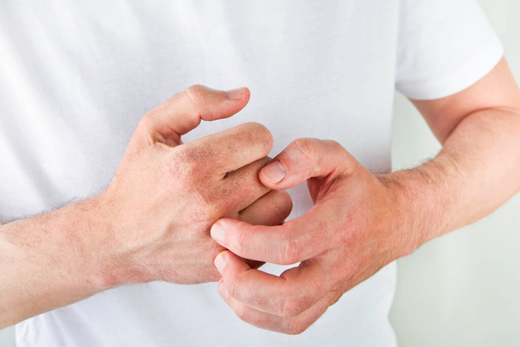 Close up of hands with irritated skin