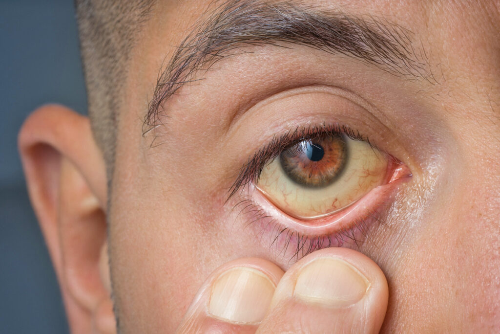 Yellow eye indicating jaundice