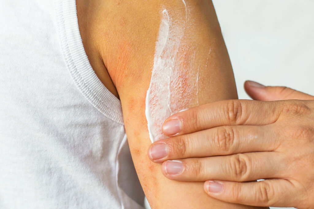 Person rubbing cream on arm