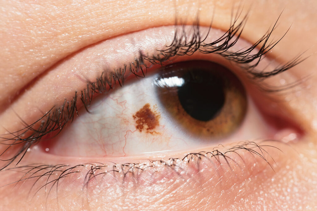 Brown spot on the white of the eye