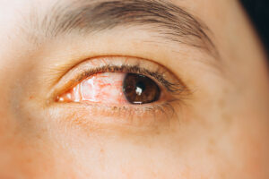 Red eye looking right