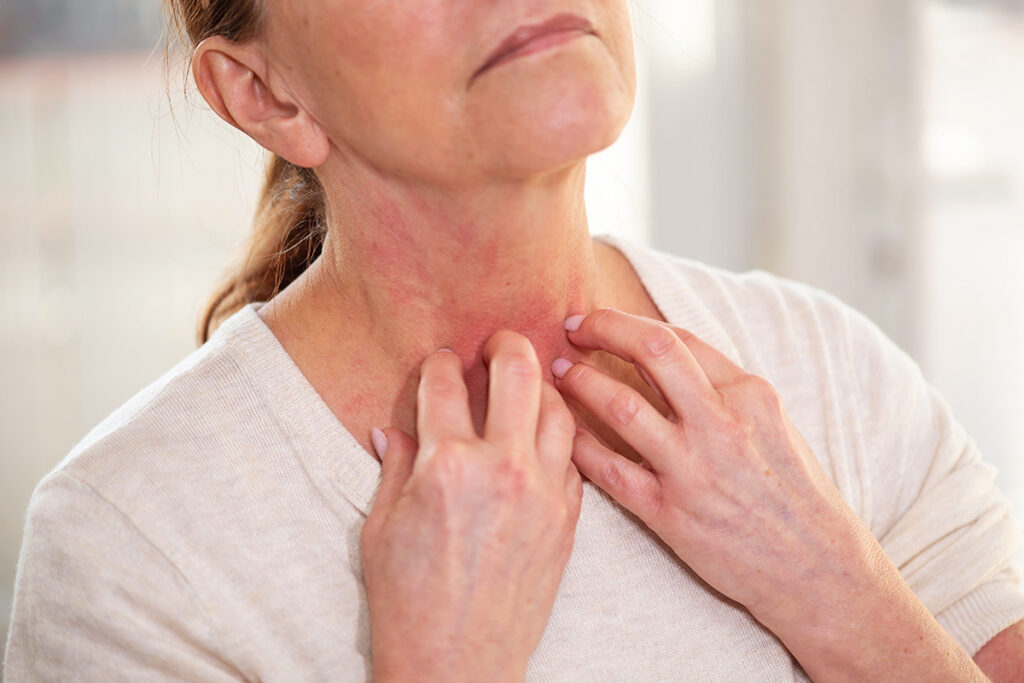 Person itching rash on throat