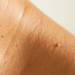 Skin tags