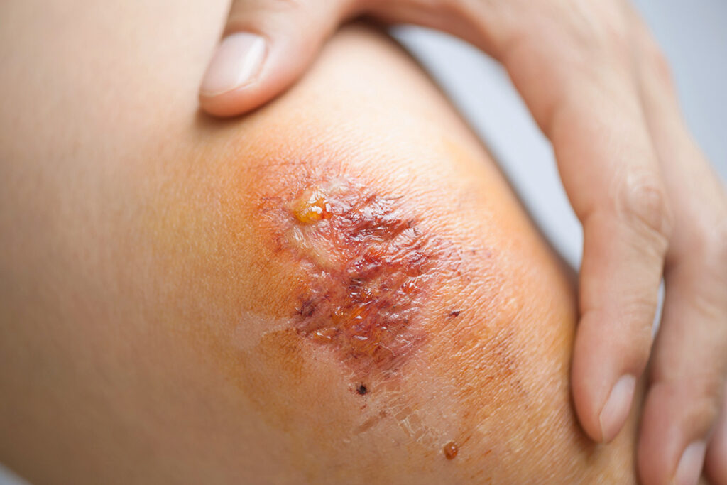 Scabbing wound