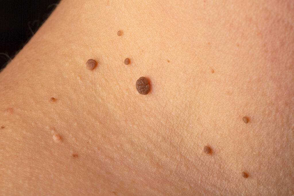 Skin tags